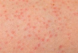 Image result for Folliculitis Anatomy