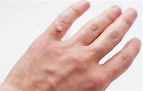 Image result for Dermal Warts