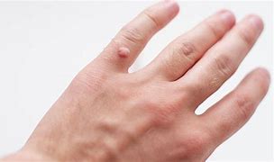 Image result for Flat vs Common Wart