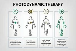 Image result for Photodynamic Therapy