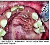 Image result for Cyst with Teeth Hair and Eyes