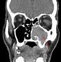 Image result for Inverted Papilloma CT Scan