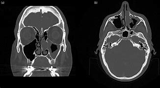 Image result for Sinonasal Schwannoma MRI