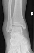 Image result for Worst Broken Bone X-ray