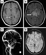 Image result for T2 MRI Veins Axial