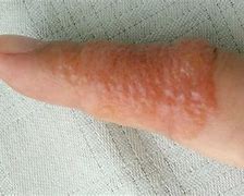 Image result for Blister Rash On Skin
