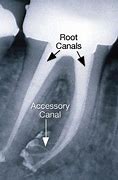 Image result for Accessory Root Canal