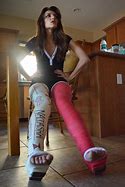 Image result for Bar with Double Leg Cast