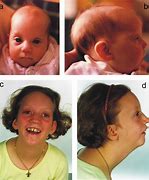 Image result for Microcephaly Eyes