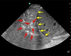 Image result for Anechoic Lung Ultrasound