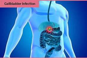 Image result for Infected Gallbladder