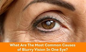 Image result for Blurry Spot in One Eye