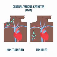Image result for Central Venous Catheter vs PICC