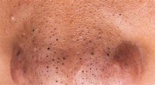 Image result for Nose Blackheads