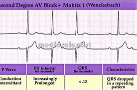 Image result for 2nd Degree Heart Block Type 1 vs 2