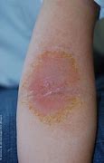 Image result for Itchy Eczema