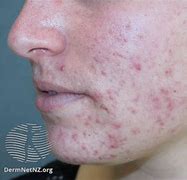 Image result for Acne