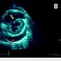 Image result for Pericardial Drain