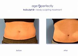 Image result for Double Chin truSculpt ID