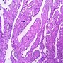 Image result for Papilloma Warts On Scalp