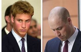 Image result for Prince William Going Bald