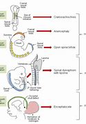 Image result for Neural Tube Disorders Anencephaly