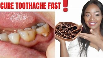 Image result for Clove Tooth Pain