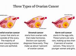 Image result for Types of Ovarian Masses