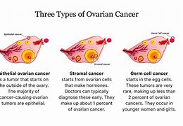 Image result for Types of Ovarian Carcinoma