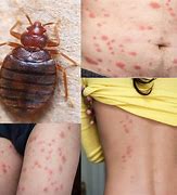 Image result for What Do Bed Bugs Bites Look Like After a Few Days