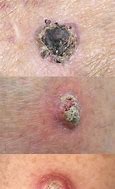 Image result for Invasive Squamous Cell Carcinoma