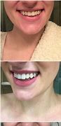 Image result for Crest Whitestrips Professional Before and After