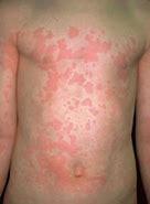 Image result for Cutaneous Eruption