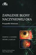 Image result for co_oznacza_zapalenie_błony_naczyniowej_oka
