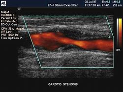 Image result for Carotid Artery Stenosis Doppler