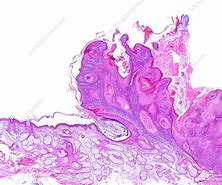 Image result for Different Warts