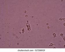 Image result for Spwerm in Urine