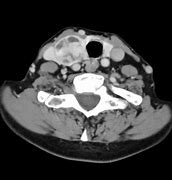 Image result for Thyroid Nodule 2 Cm