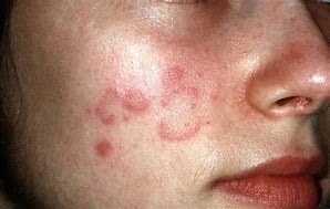 Image result for Skin Eruptions