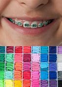 Image result for Nice Braces Colors