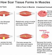 Image result for Scar Tissue in Foot Arch