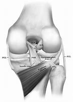 Image result for ACL Rupture