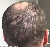 Image result for alopeciz