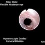 Image result for 21 FR Dialated Cervix Graphic