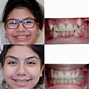 Image result for Treatment of Long Front Teeth with Braces Before and After