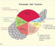 Image result for Endocrine Tumor in Pancreas