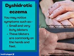 Image result for 7 Types of Eczema