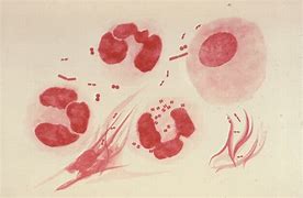 Image result for gonorrea