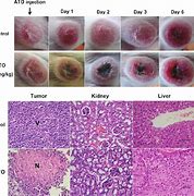 Image result for Necrotic Tumor