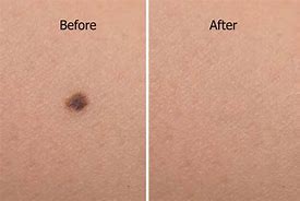 Image result for Cryotherapy Mole Removal Before and After